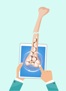 ยาดีโนซูแมบยังไม่คุ้มค่าฯ แต่เป็นทางเลือกในการรักษาภาวะกระดูกพรุนสำหรับผู้ป่วยโรคไตเรื้อรังระยะที่ 3b และ 4