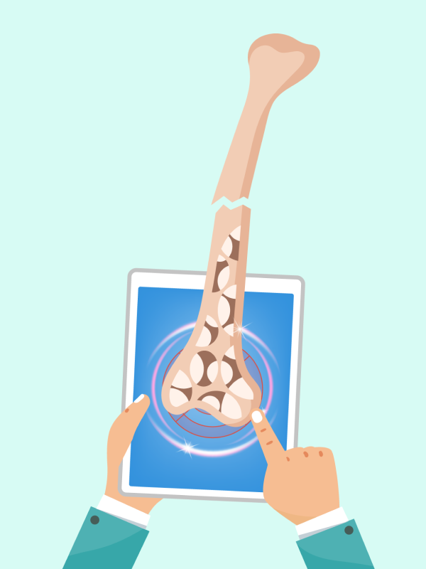 ยาดีโนซูแมบยังไม่คุ้มค่าฯ แต่เป็นทางเลือกในการรักษาภาวะกระดูกพรุนสำหรับผู้ป่วยโรคไตเรื้อรังระยะที่ 3b และ 4