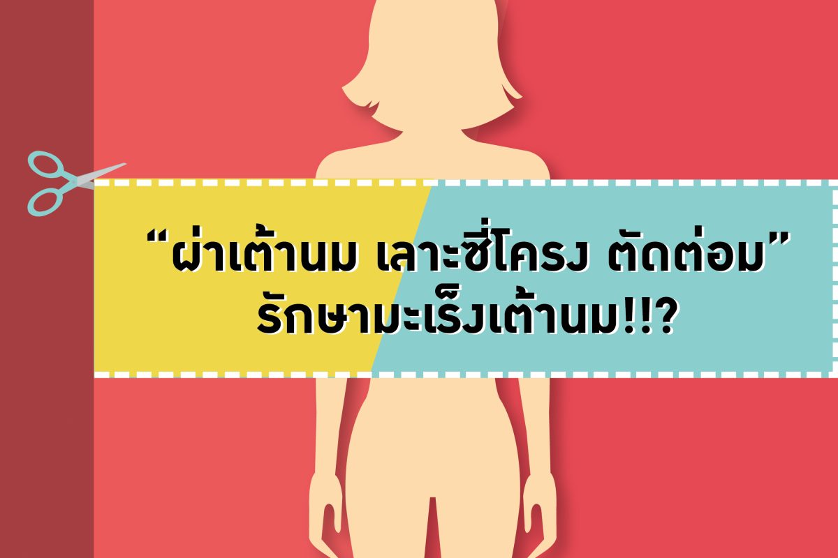 ย้อนบทเรียน “ผ่าเต้านม เลาะซี่โครง ตัดต่อมน้ำเหลือง” เพื่อรักษามะเร็งเต้านม