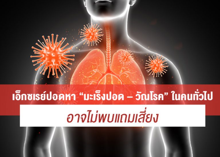 เอ็กซเรย์ปอดหา “มะเร็งปอด – วัณโรค” ในคนทั่วไปอาจไม่พบแถมเสี่ยง