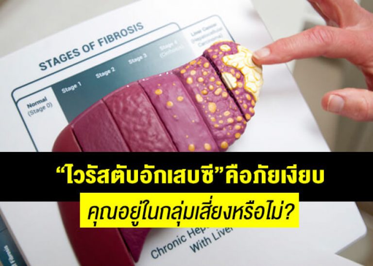 “ไวรัสตับอักเสบซี” คือภัยเงียบ…คุณอยู่ในกลุ่มเสี่ยงหรือไม่?
