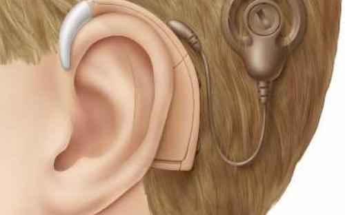 เปลี่ยนชีวิตในโลกเงียบ ด้วยประสาทหูเทียม