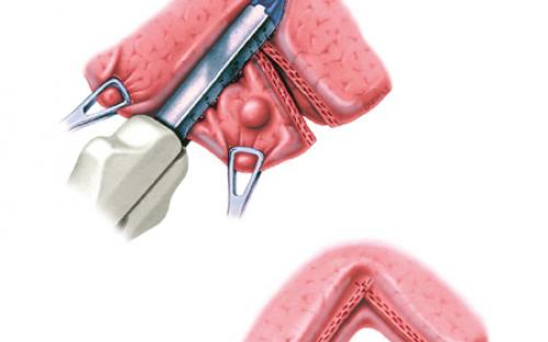 วิจัยพบ เย็บปอดด้วยแม็กไม่ต่างจากเย็บด้วยมือ ช่วยย่นเวลาผ่าตัดและพักฟื้น …คนไข้บัตรทองเบิกได้!