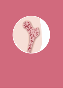 รายงานวิจัย: การประเมินความคุ้มค่าของการคัดกรองและการรักษาโรคกระดูกพรุนในผู้หญิงวัยหมดประจำเดือน