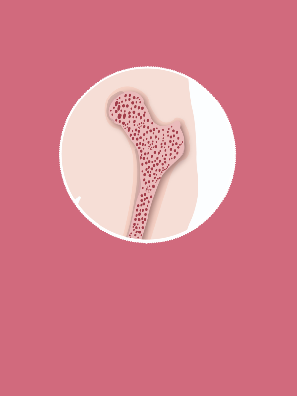 รายงานวิจัย: การประเมินความคุ้มค่าของการคัดกรองและการรักษาโรคกระดูกพรุนในผู้หญิงวัยหมดประจำเดือน