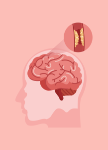 ความคุ้มค่าในการรักษาโรคหลอดเลือดอุดตันระยะเฉียบพลันผ่านสายสวนหลอดเลือดด้วยวิธี endovascular treatment