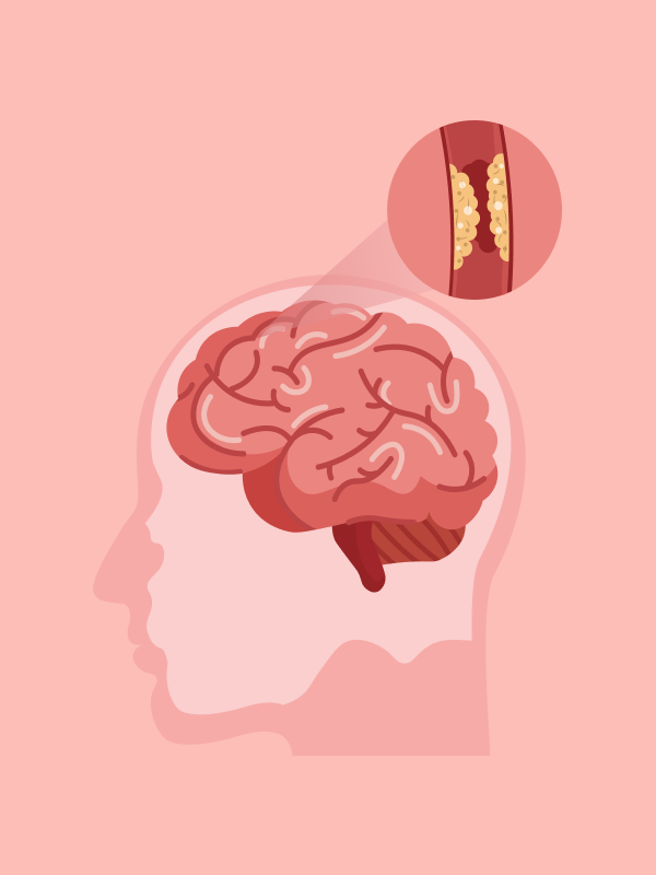 ความคุ้มค่าในการรักษาโรคหลอดเลือดอุดตันระยะเฉียบพลันผ่านสายสวนหลอดเลือดด้วยวิธี endovascular treatment