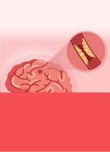 รายงานฉบับสมบูรณ์: การประเมินต้นทุนอรรถประโยชน์ของการรักษาผู้ป่วยโรคหลอดเลือดสมองอุดตันระยะเฉียบพลันผ่านสายสวนหลอดเลือดด้วยวิธี endovascular treatment ในประชากรไทย