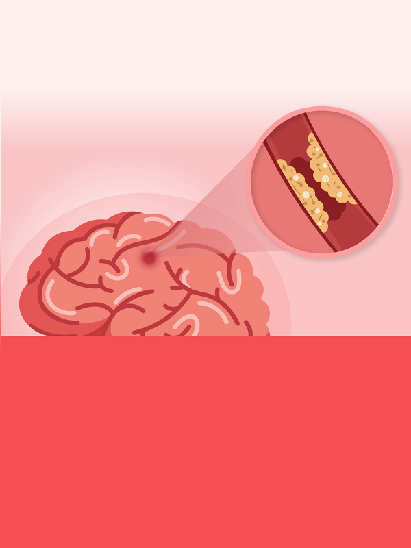 รายงานฉบับสมบูรณ์: การประเมินต้นทุนอรรถประโยชน์ของการรักษาผู้ป่วยโรคหลอดเลือดสมองอุดตันระยะเฉียบพลันผ่านสายสวนหลอดเลือดด้วยวิธี endovascular treatment ในประชากรไทย