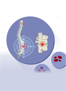 รายงานฉบับสมบูรณ์: การประเมินความคุ้มค่าของการปลูกถ่ายเซลล์ต้นกำเนิดในผู้ป่วยมะเร็งไขกระดูก