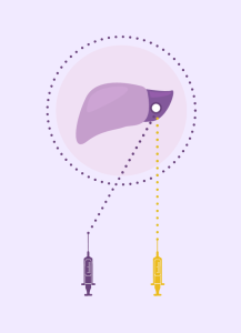 iodized oil fluid injection ตัวนำยาเคมีบำบัดที่ยังแพงเกินไปสำหรับรักษามะเร็งตับชนิดเอชซีซีระยะกลางด้วยวิธี TACE