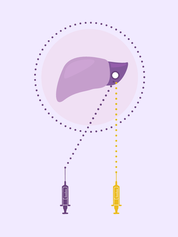 iodized oil fluid injection ตัวนำยาเคมีบำบัดที่ยังแพงเกินไปสำหรับรักษามะเร็งตับชนิดเอชซีซีระยะกลางด้วยวิธี TACE