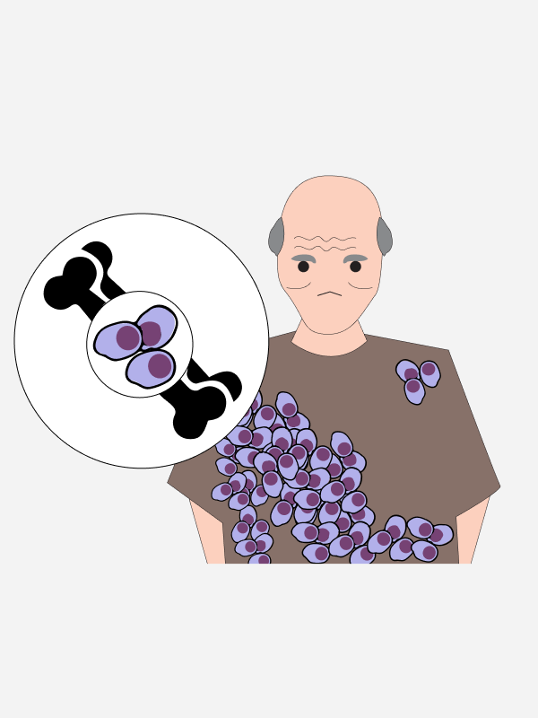 ยาเบอร์ทีโซมิบ ยาทาลิโดไมด์ และยาเลนาลิโดไมด์ ยาทางเลือกใหม่ของผู้ป่วยโรคมะเร็งเม็ดเลือดขาว ชนิดมัยอีโลมาที่มีภาวะกลับเป็นซ้ำ