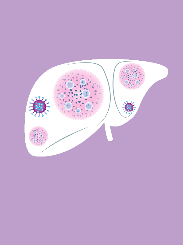 รายงานวิจัย: การประเมินความคุ้มค่าทางการแพทย์และผลกระทบด้านงบประมาณของการรักษาโรคติดเชื้อไวรัสตับอักเสบซีชนิดเรื้อรัง