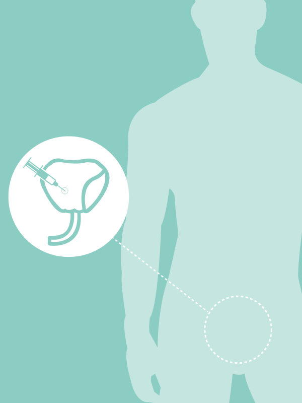 รายงานวิจัย: การประเมินต้นทุนอรรถประโยชน์และผลกระทบทางด้านงบประมาณของ ยากลุ่ม Luteinizing hormone-releasing hormone analogues ในข้อบ่งใช้สาหรับมะเร็งต่อมลูกหมากใน Adjuvant therapy และระยะ Metastatic disease